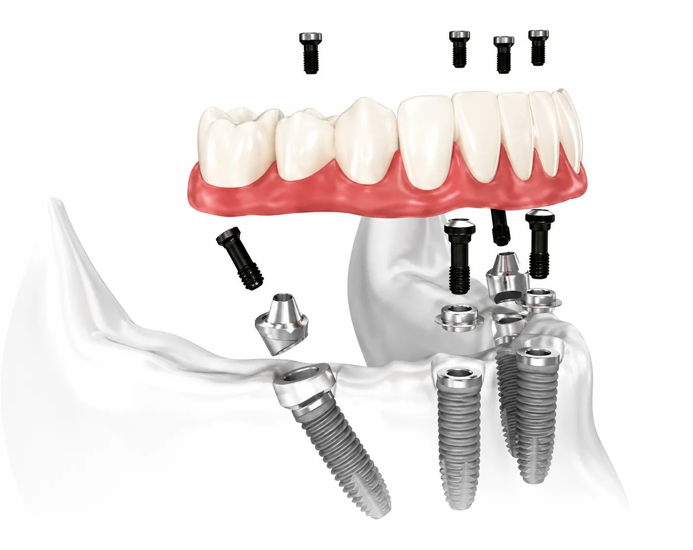All-on-4 dental implant system showing four implants supporting full arch of teeth