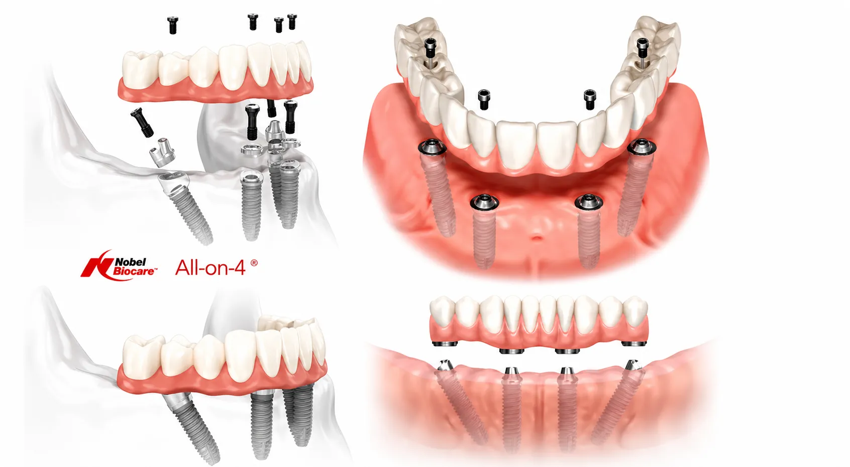 All-on-4 implant procedure diagram showing angled posterior implants by Nobel Biocare