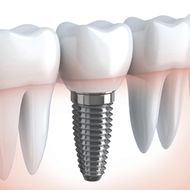 Dental Implants Picture